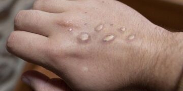 Dünyada meymunçiçəyinə yoluxanların sayı 62 mini ötüb