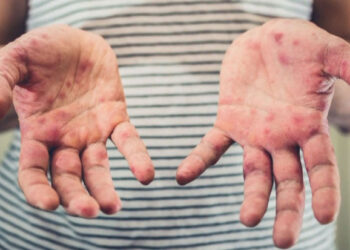 Cəlilabadda qızılcaya yoluxan tələbələr evə buraxılıblar – RƏSMİ + YENİLƏNİB