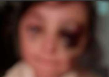 İkinci sinif şagirdini məktəbdə döyüblər? – Foto+Yenilənib