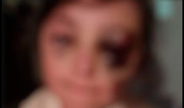 İkinci sinif şagirdini məktəbdə döyüblər? – Foto+Yenilənib