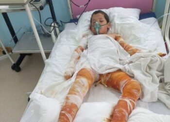 Bədəni yanan Sərxanın anası: “Bəzən yemək almağa belə pul tapmıram” – FOTO