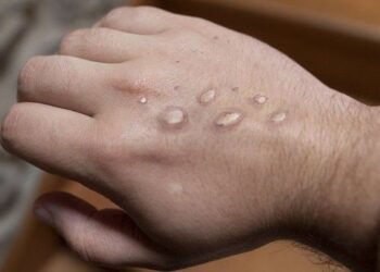 Dünyada meymunçiçəyinə yoluxanların sayı 62 mini ötüb