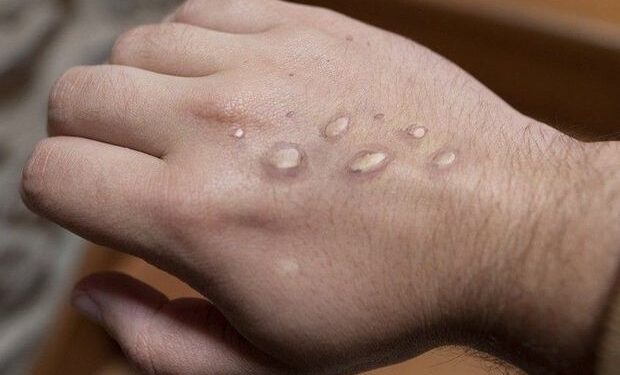 Dünyada meymunçiçəyinə yoluxanların sayı 62 mini ötüb