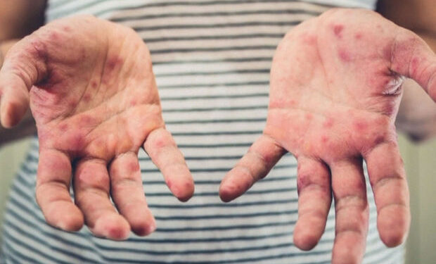 Cəlilabadda qızılcaya yoluxan tələbələr evə buraxılıblar – RƏSMİ + YENİLƏNİB