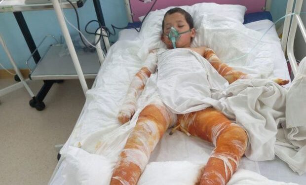 Bədəni yanan Sərxanın anası: “Bəzən yemək almağa belə pul tapmıram” – FOTO